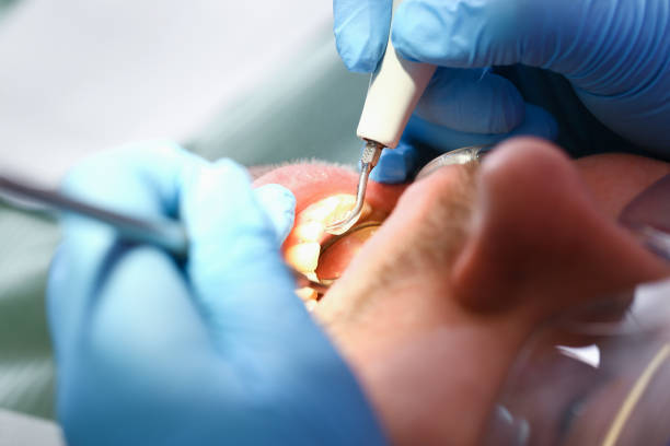 Emergency Dental Fillings