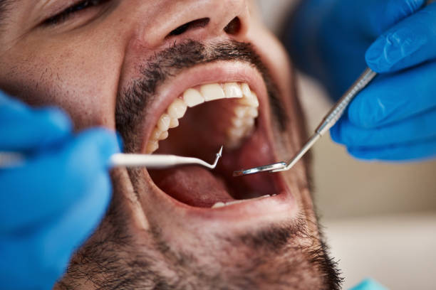 Best Emergency Wisdom Teeth Removal in Morris, MN